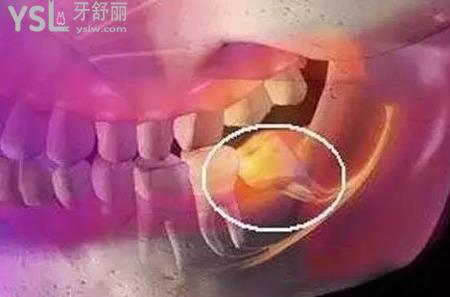 牙長(zhǎng)智齒特別疼怎么辦？