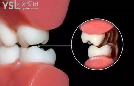 牙后根腫痛怎么回事？