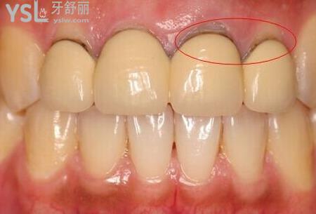 牙根發(fā)黑怎么治療？