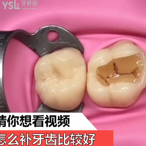 怎么補(bǔ)牙齒比較好？