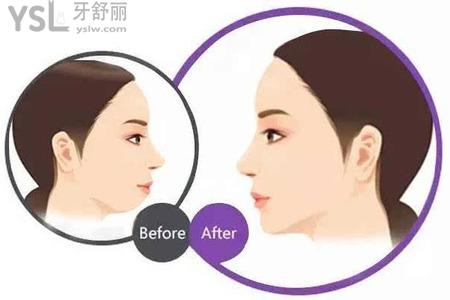下巴松弛下垂怎么辦？