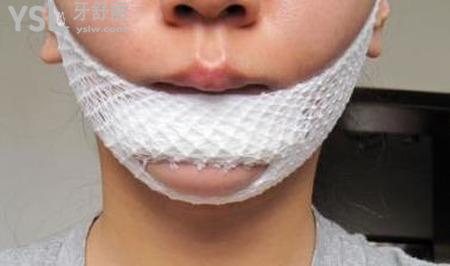 膨體隆下巴終身不取行嗎？
