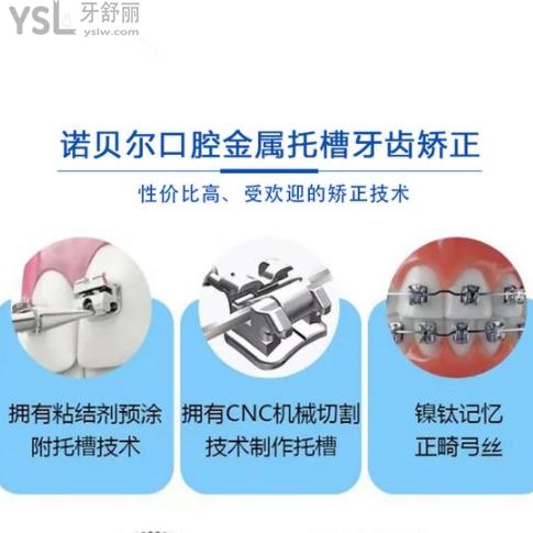 來銀川諾貝爾口腔2周年正畸活動!兩人同行做金屬托槽矯正價格4999元起