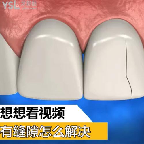 門牙有縫隙怎么解決？