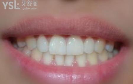 瓷貼面修復(fù)的注意事項有哪些？