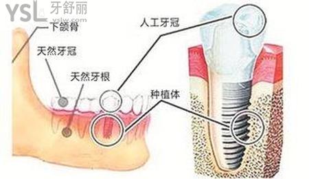 種植牙出現(xiàn)了牙齦狀況怎么辦？