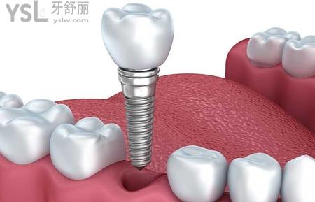 種植義齒的成功標(biāo)準(zhǔn)有哪些？