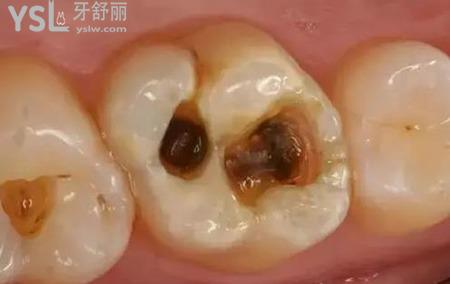 大牙上有黑點是怎么回事？