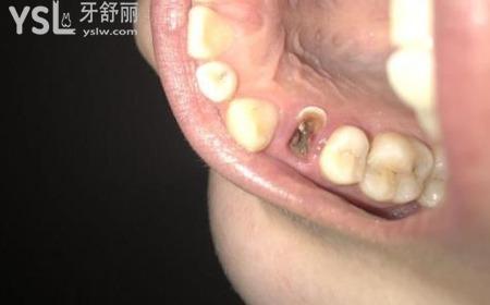 牙根爛掉了怎么辦？