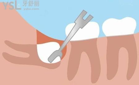拔磨牙后一般要疼幾天？