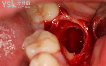 拔過智齒后有一個洞怎么辦？