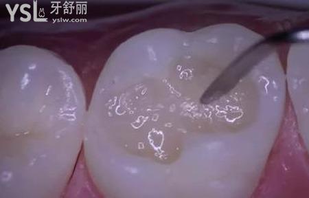 牙齒空了一半可以補(bǔ)嗎？