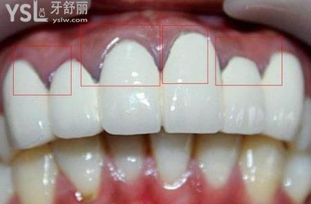 牙齒全掉完了能做烤瓷牙嗎？