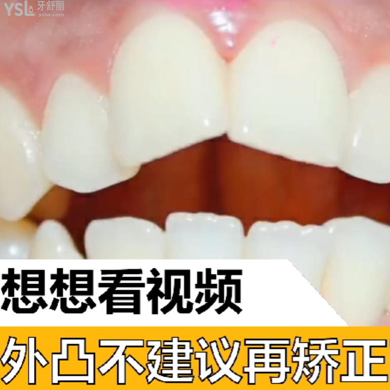 門牙外凸不建議再矯正了？
