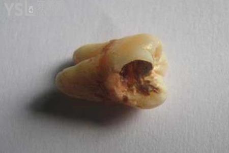 智齒拔牙多久能好？