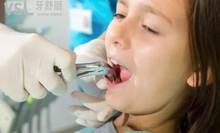 牙痛的時候可以拔牙嗎？