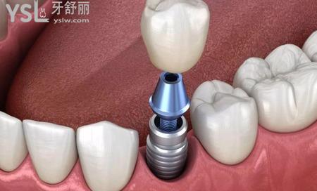 種植牙壽命是多長？