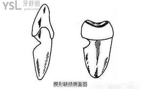 楔狀缺損補牙多少錢？