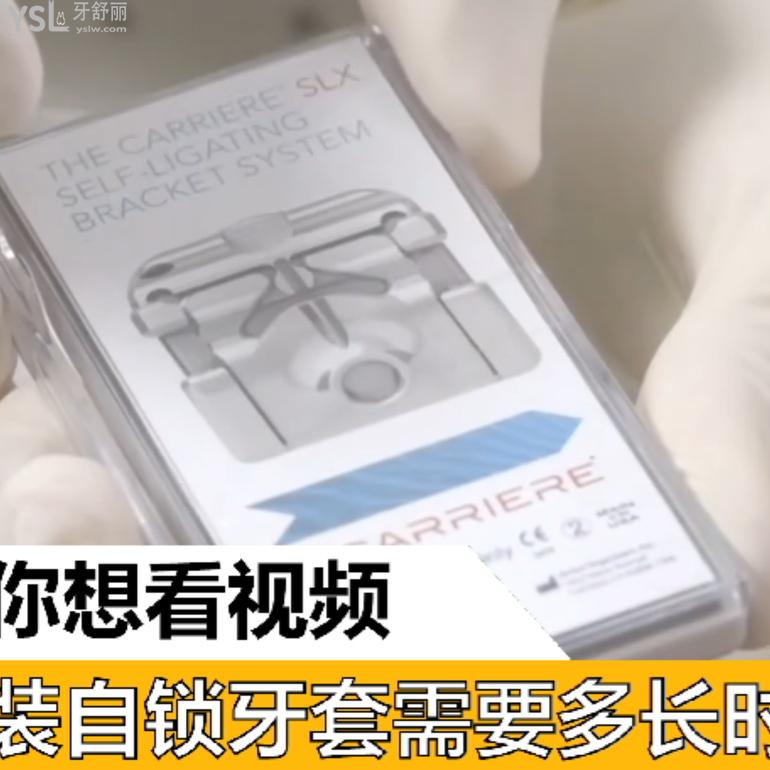 安裝自鎖牙套需要多長時間