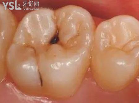 蛀牙會傳染相鄰的牙嗎？