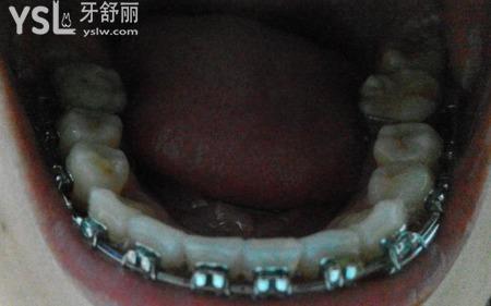 戴牙套有年齡限制嗎？