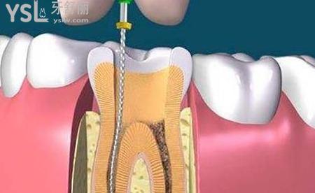 牙齒根管治療后需要做牙套嗎？
