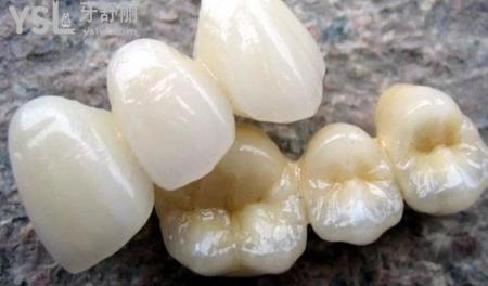陶瓷牙一顆多少錢？