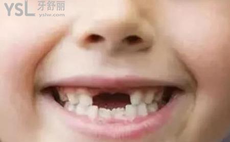 牙齒掉了多久能長(zhǎng)出來(lái)？