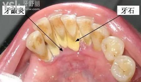 洗牙結(jié)石需要多少錢？