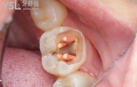 牙齒根管治療是怎么回事？