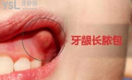 牙銀上長個膿包怎么辦？