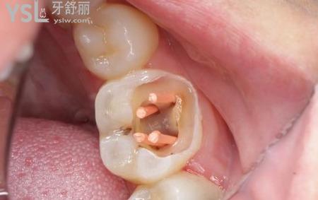 牙科根管治療是什么？