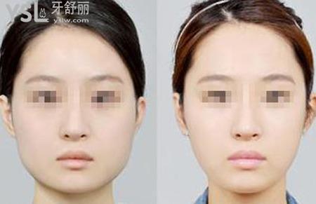 下頜角手術有危險嗎？