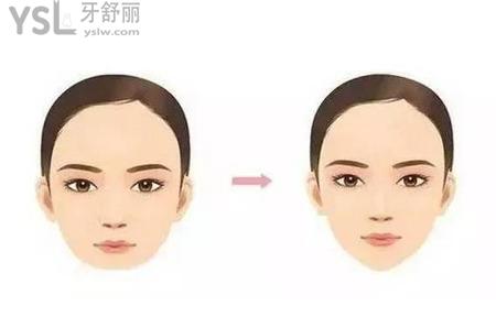磨顴骨會下垂嗎？