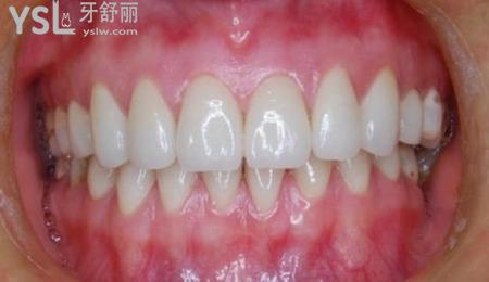 牙槽突裂是怎么發(fā)育的？