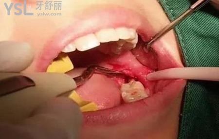 拔智齒后一周吃什么？