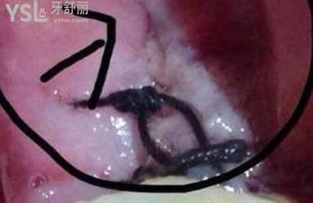 拔牙縫針不拆線后果是什么？