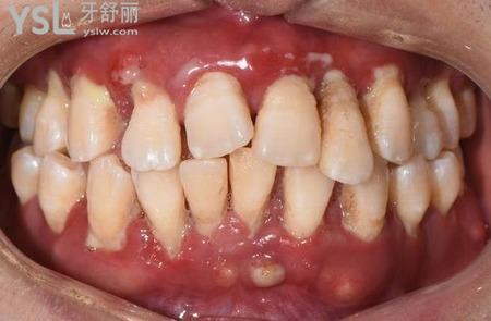 牙齒軟是什么原因？