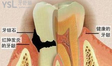 牙周炎有什么癥狀？