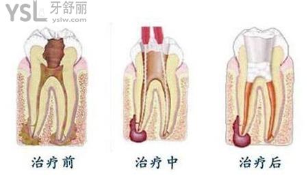 根管治療第二次做什么？