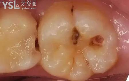 如果牙齒有洞怎么辦？