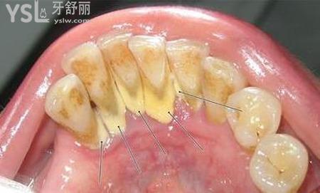 牙齒上有黃垢怎么辦？