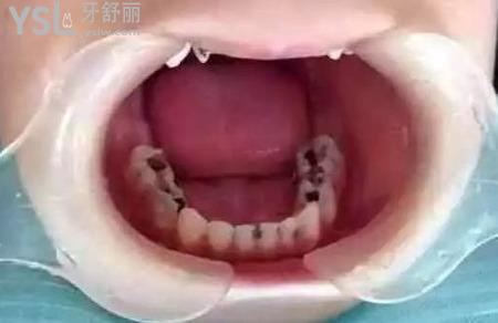 蛀牙引起的牙痛怎樣緩解？