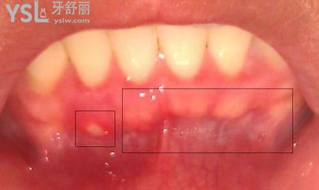 牙齦腫痛不能吃什么東西？