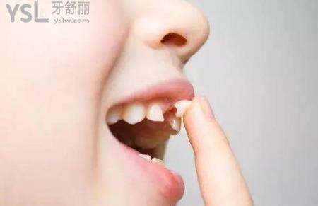 乳牙畸形怎么辦？