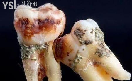 阻生齒拔掉后有個洞怎么辦？
