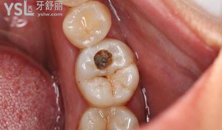 齲齒會痛嗎？