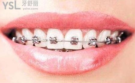 30歲矯正牙齒需要多長時間？
