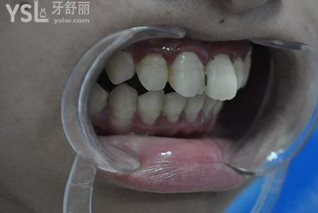 牙齒上排突出怎么辦？