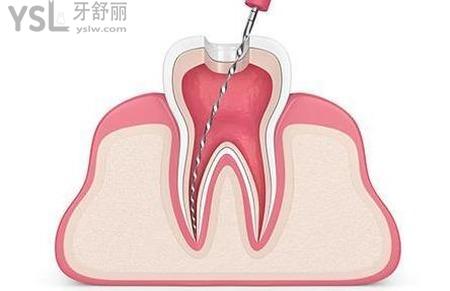 牙神經(jīng)疼的好的怎么辦？